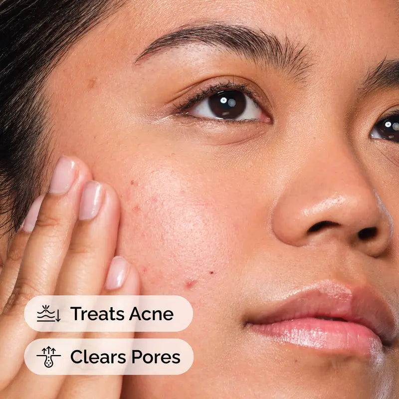 The Acne Set with Salicylic Acid, Foaming Cleanser and Hydrating Moisturizer Skincare Routine