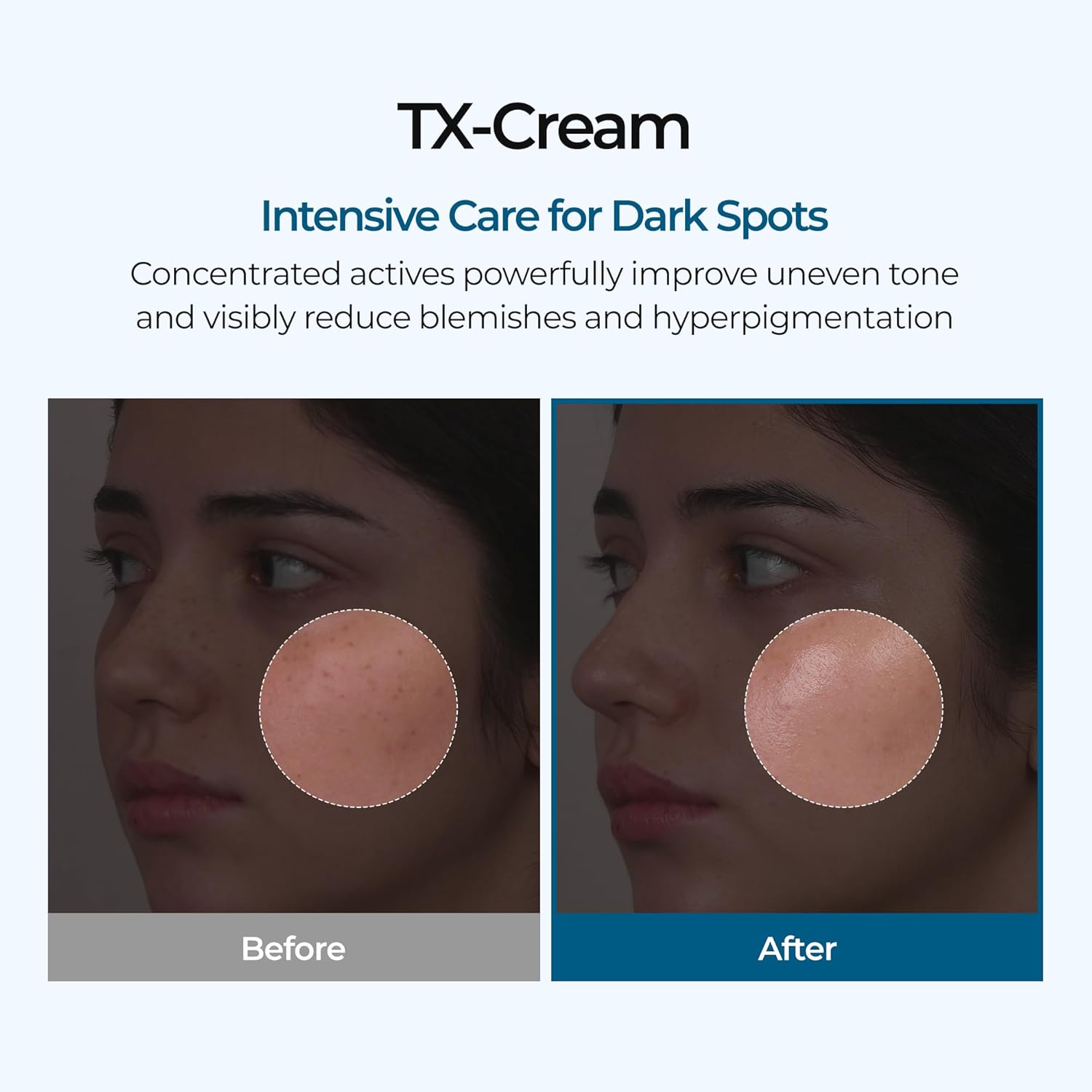 TX Tranexamic Acid Cream — Dark Spots, Hyperpigmentation & Uneven Tone, 50ml