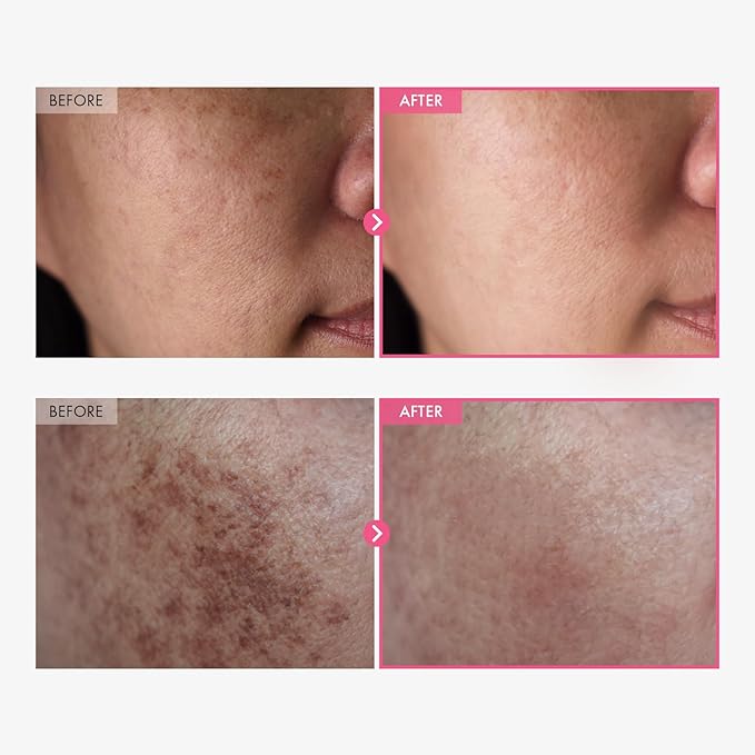 Arbutin 7% & Tranexamic Acid 4% Cream with Niacinamide & Glutathione for Dark Spots — 50ml